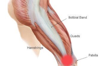 Douleur dans la ceinture iliotibiale