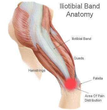 Douleur dans la ceinture iliotibiale