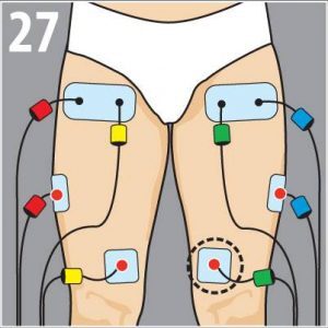 tendinitis compex