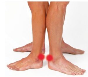 Treat Achilles tendon with COMPEX