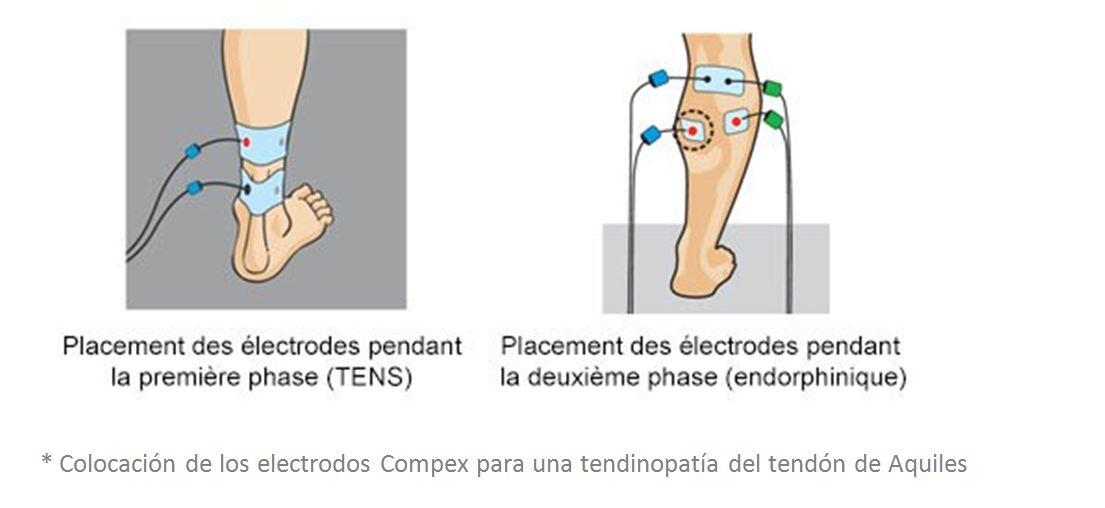 Traiter le tendon d'Achille avec COMPEX