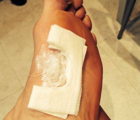 Behandlung einer Blase