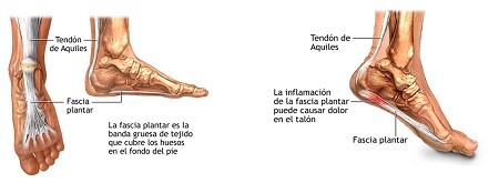 Fascitis Plantar con COMPEX