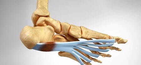 Fasciíte plantar com COMPEX