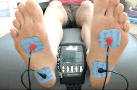 Plantar Fasciitis mit COMPEX