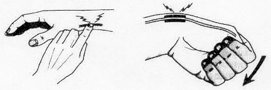 Tendinitis de Quervain 