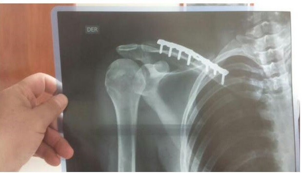 María Ortega's broken clavicle