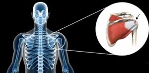 Shoulder injury rotator cuff