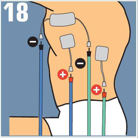 Colocación de electrodos en Dorsal Ancho