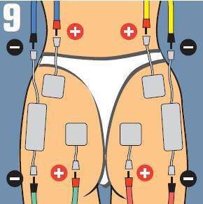 Placement of electrodes in Buttocks