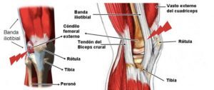 Lesión de la fascia lata y cintilla iliotibial