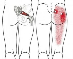 Pyramidal syndrome