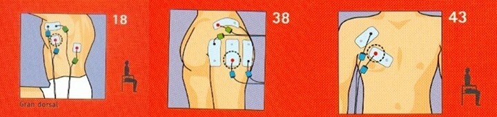 Electrode placement Procotolo COMPEX rotator cuff