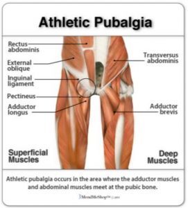 Causes and treatment of Pubalgia