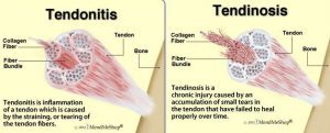 Differences between tendinitis and tendinosis