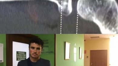 Javier Gómez Noya con su fractura de brazo