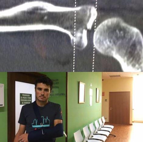 Javier Gómez Noya con su fractura de brazo