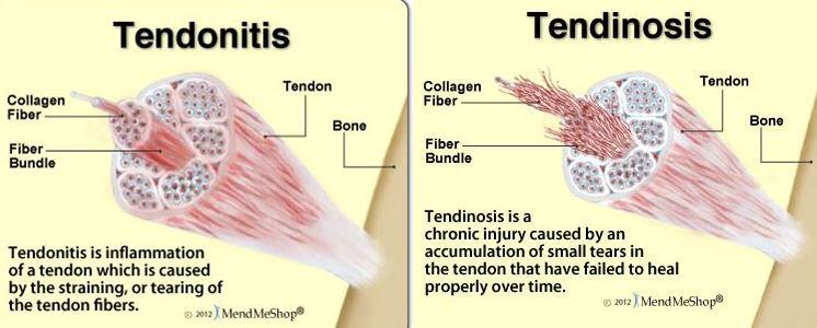 Unterschiede Verletzung Tendinitis Tendinose