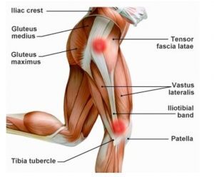 Formazione per evitare la sindrome della bandelletta ileotibiale