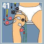 Colocación compex para protocolo ligamento cruzado