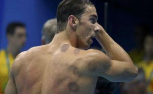Use of "Cupping" on the swimmer's shoulder