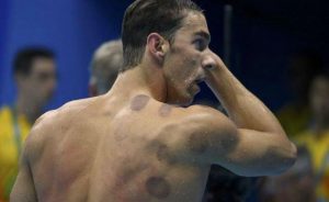 Uso del “Cupping” en el hombro del nadador