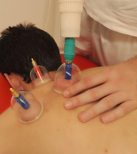 Tratamiento del “Cupping” en el hombro del nadador