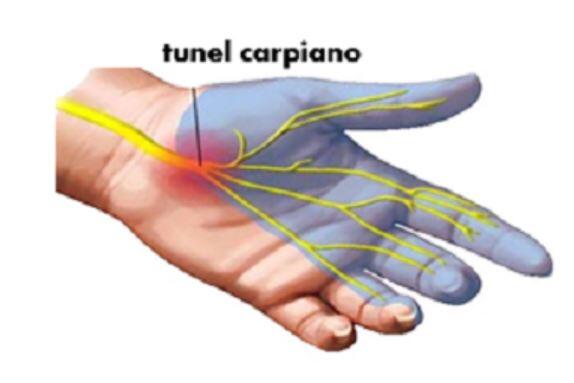 Sindrome del tunel carpiano car