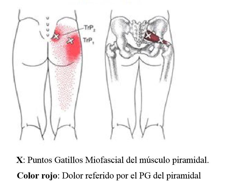 Pontos de gatilho miofasciais do músculo piramidal