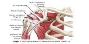 ¿Qué es la tendinopatía del supraespinoso?