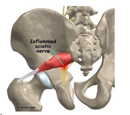 Sciatic nerve entrapment caused by the left pyramidal muscle