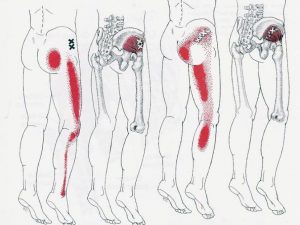 Tout sur le syndrome pyramidal