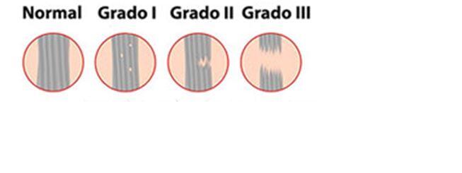 Gradi di distorsione della caviglia