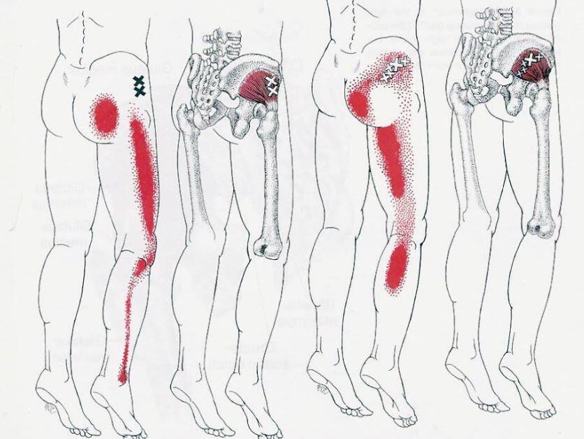 Sindrome piramidale