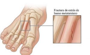 Causes and treatments of stress fractures