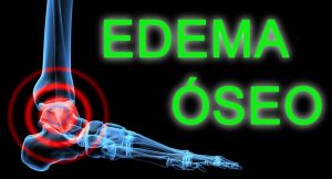 Causas y tratamiento del Edema óseo