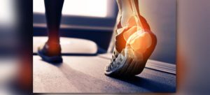 Achilles tendinopathy How does it affect the Triathlete?