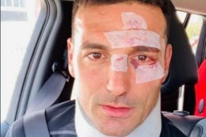Scaloni, seleccionador argentino de fútbol, arrollado por un coche mientras entrenaba en bici en Mallorca