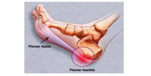 Fascitis Plantar