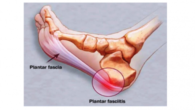 Fasciite plantaire