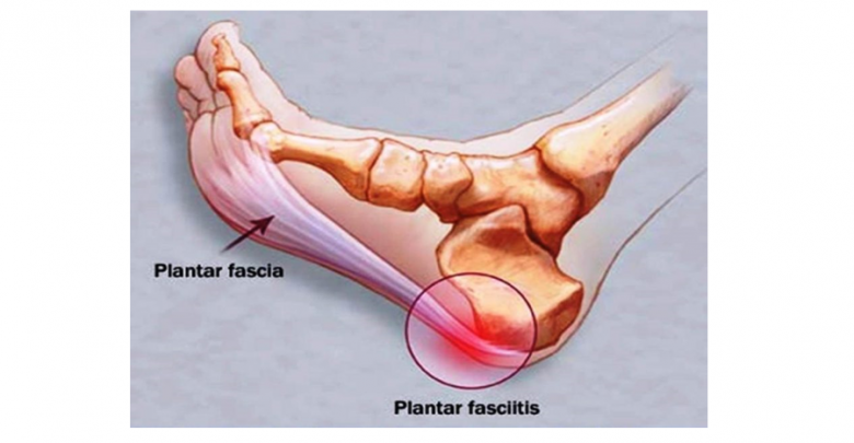 fascite plantare