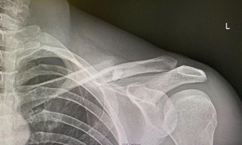 Sebastian Kienle clavicle x-ray