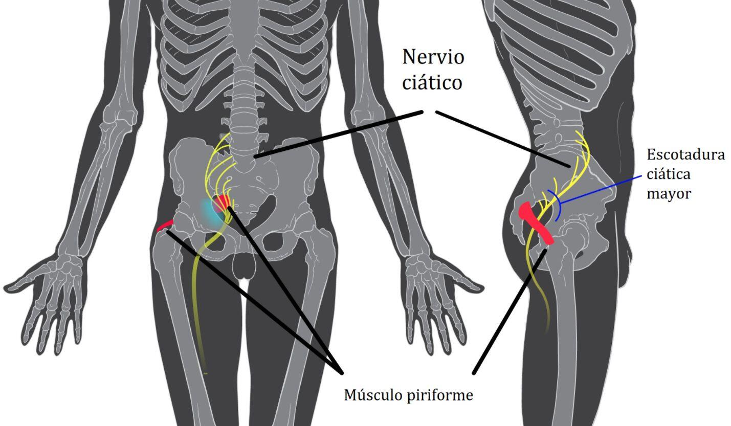 Síndrome do piriforme